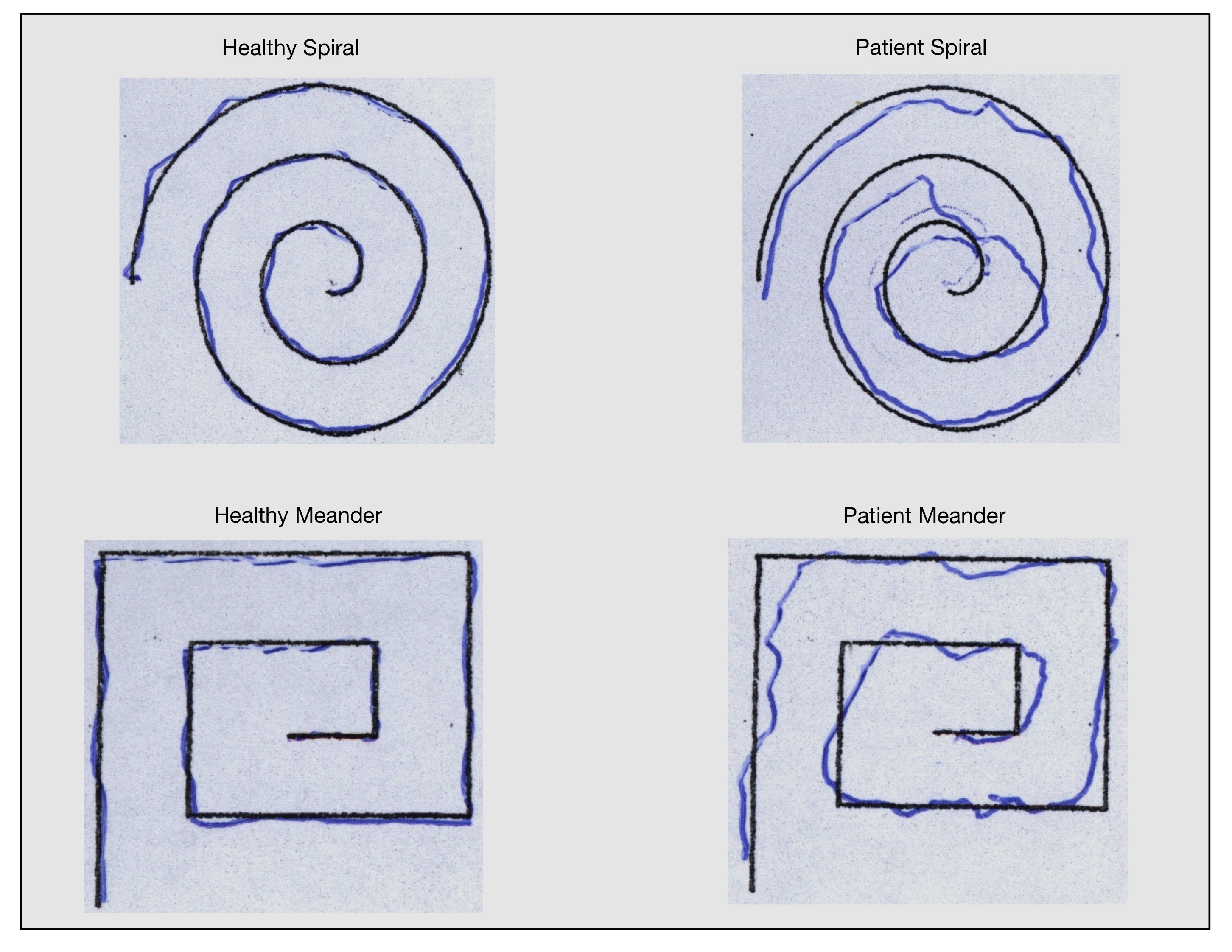 MultiModel for Early Diagnosis of Parkinson’s Disease